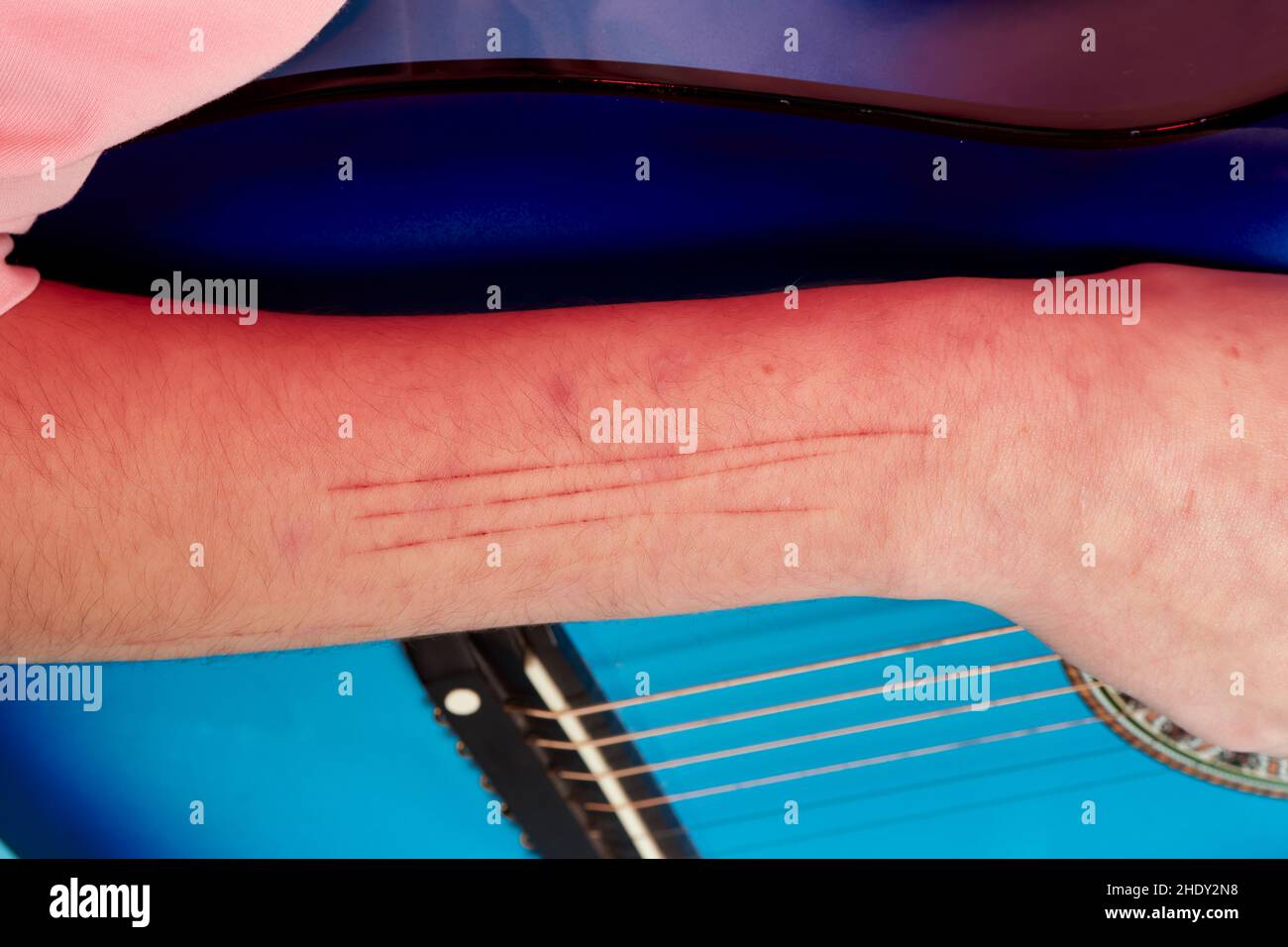 The skin condition after cat scratch and bite of veterinary surgeon