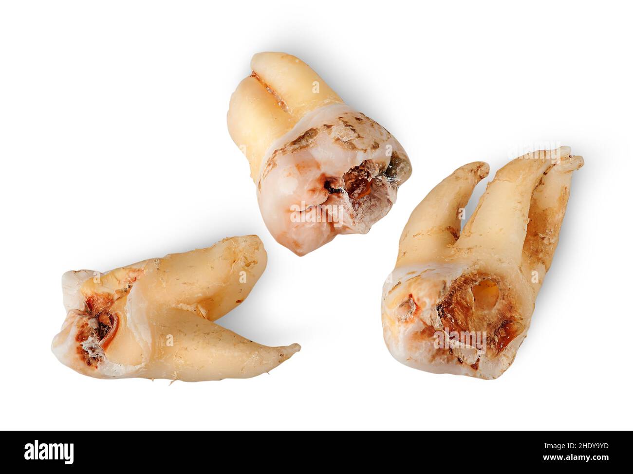 caries, tooth, tooth root, tooths, tooth roots Stock Photo