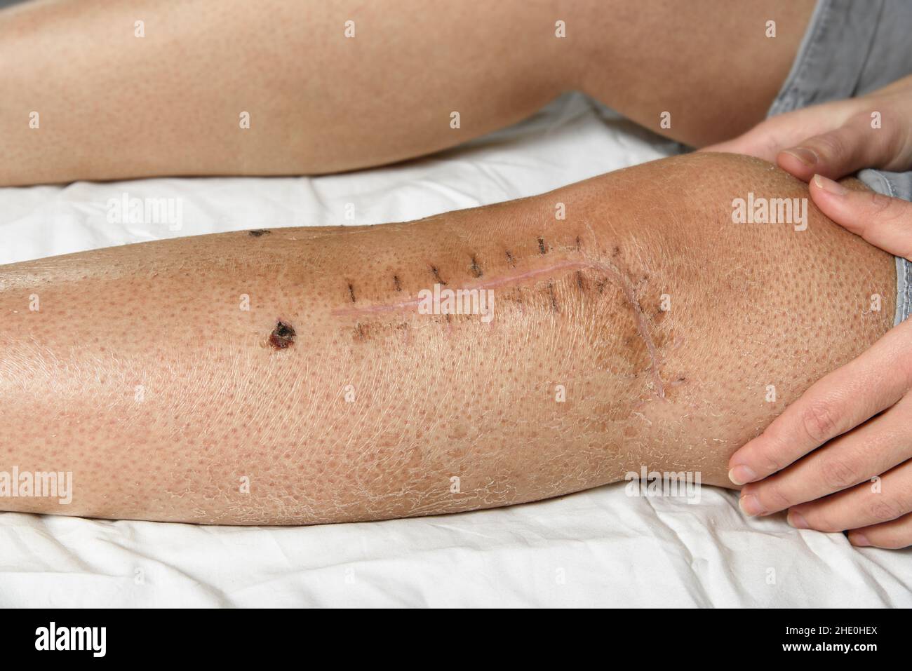 Scar on the Leg, after Injury. the Last Stage of Wound Healing, Scarring  Stock Image - Image of health, help: 192692833