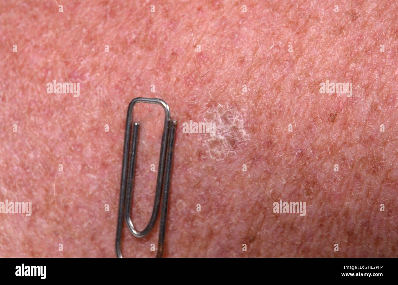 Solar keratosis on human skin, the paper clip serves as size reference. Stock Photo