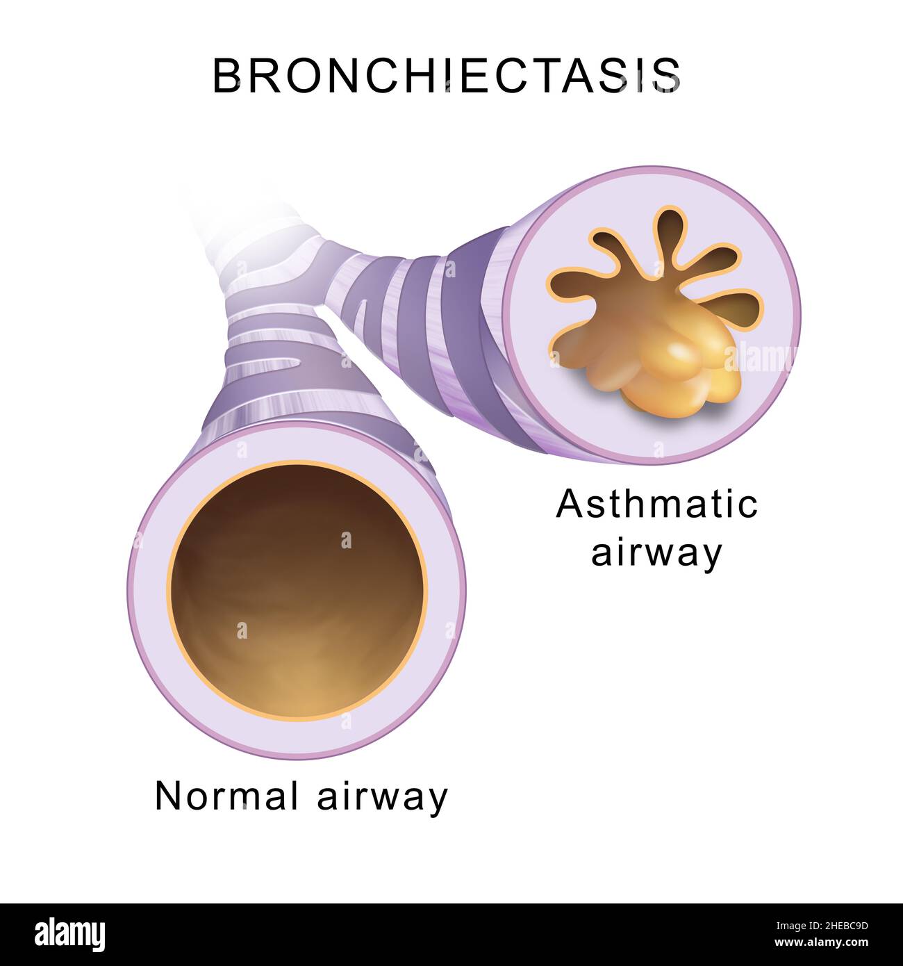 Bronchiectasis. Normal airway and asthmatic airway Stock Photo