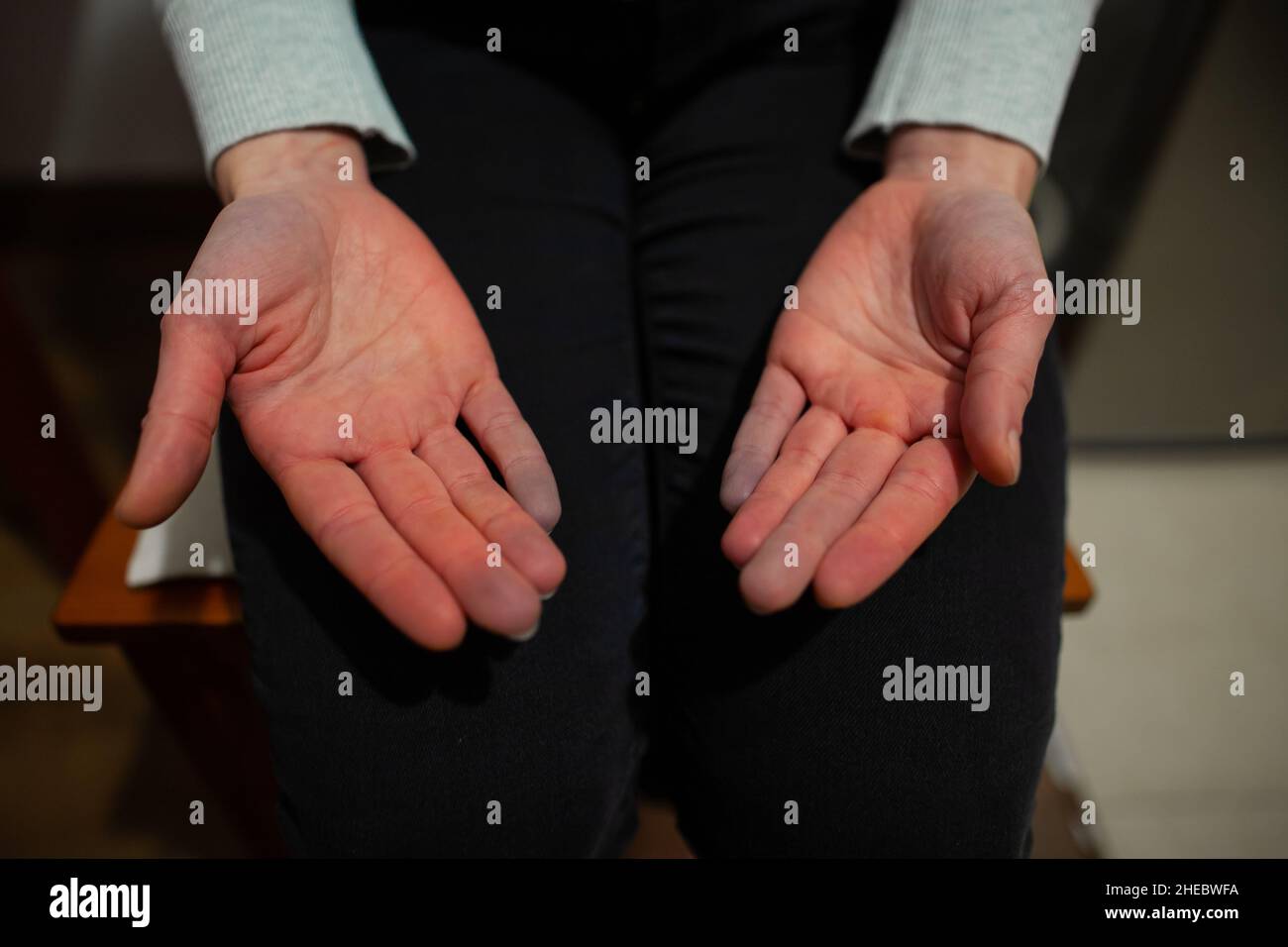 Hands of person with Raynaud's phenomenon during attack with some fingers turned blue after white, color change Raynaud’s syndrome Raynaud disease Stock Photo