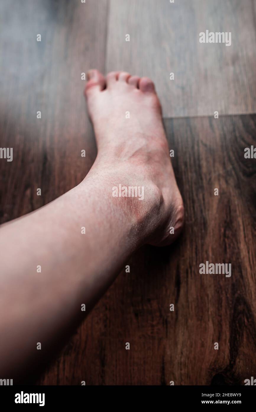 Leg of person with both Raynaud and Ehlers-Danlos (EDS) syndrome on brown floor, Swollen toes, Damaged skin and nails, Extremely dry skin, Raynaud’s Stock Photo