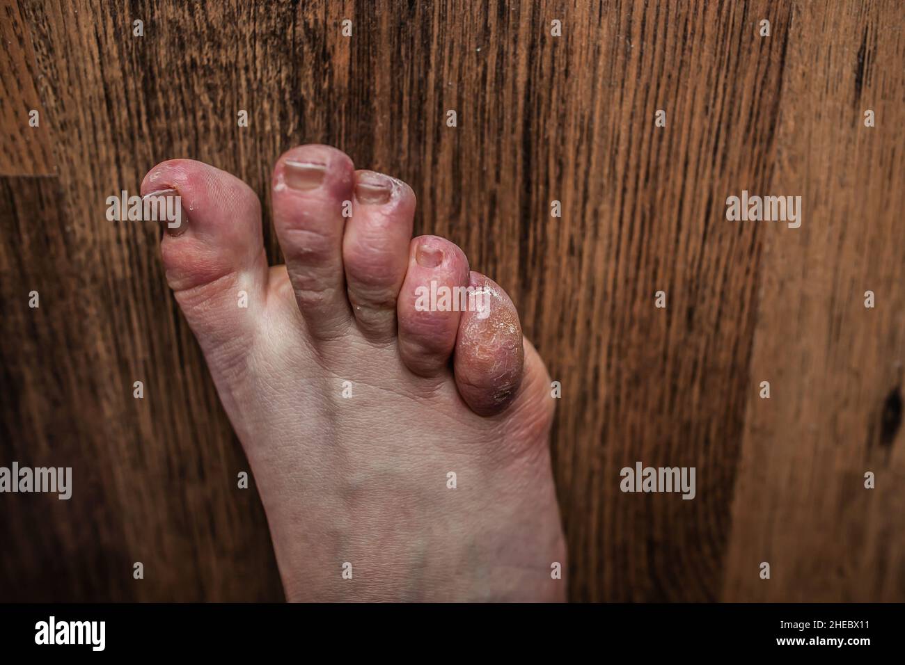 Ehlers-Danlos (EDS) syndrome 