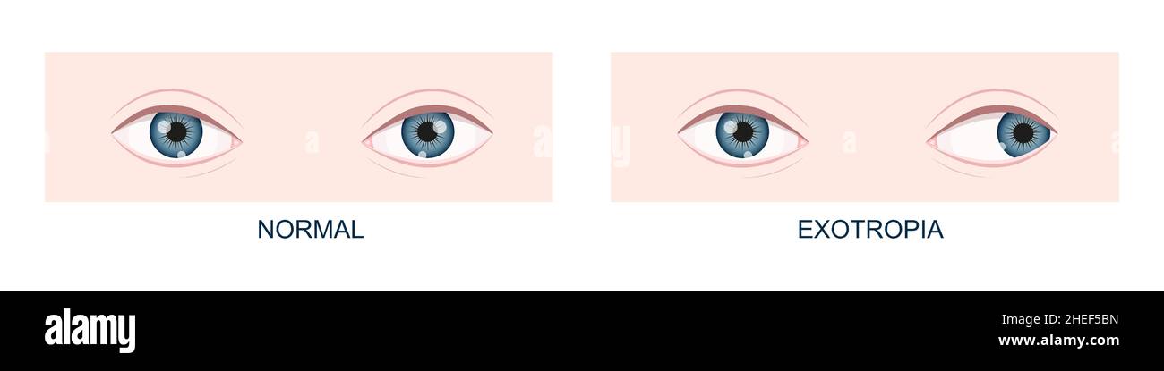 Exotropia. Horizontal strabismus before and after surgery. Eye misalignment, cross-eyed condition. Human eyes healthy and with outward gaze position. Double vision. Vector cartoon illustration Stock Vector