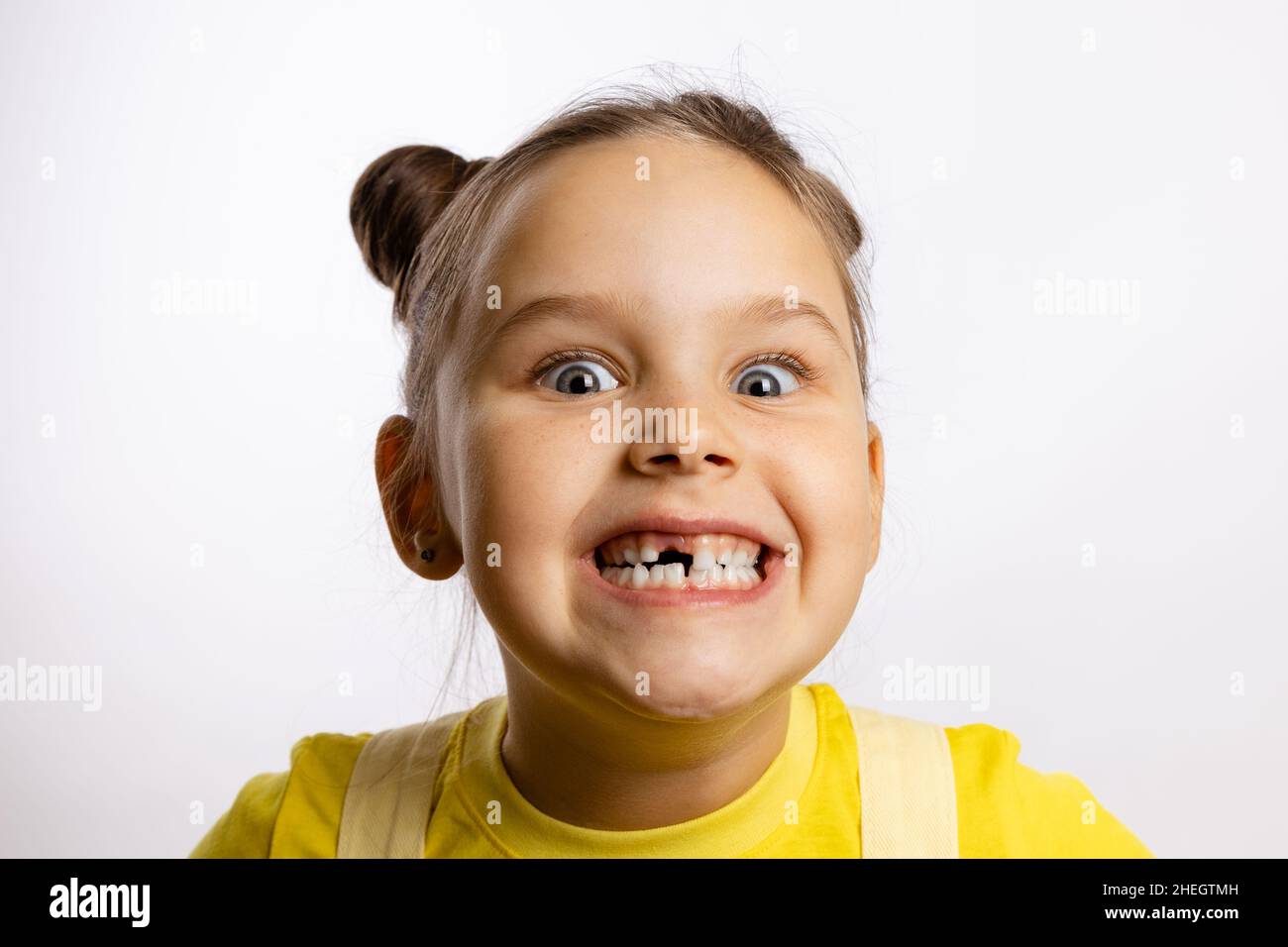 Portrait of little girl showing missing front baby tooth and smiling crazily with bulging eyes in yellow t-shirt on white background. First teeth Stock Photo