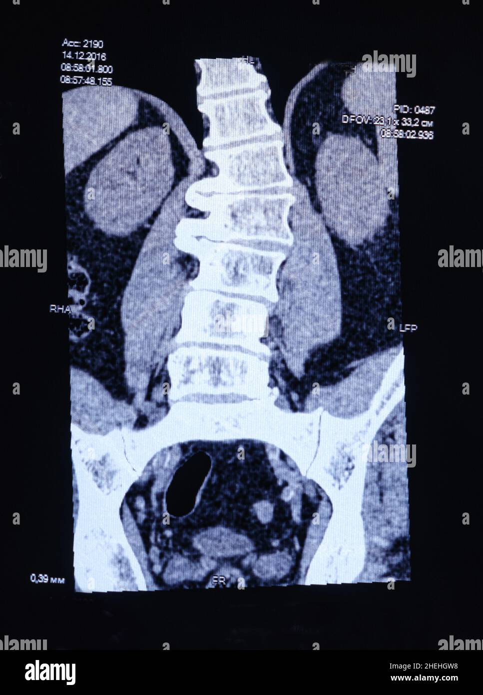 CT image of the spine of a patient with scoliosis and protrusion of the intervertebral disc. Stock Photo
