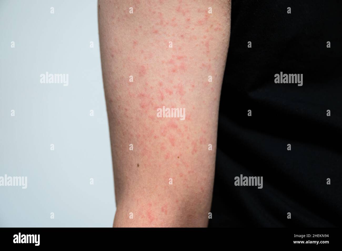 Dermatitis rash viral disease with immunodeficiency on arm of young adult asian, scratch with itch, Measles Virus, Viral Exanthem Stock Photo