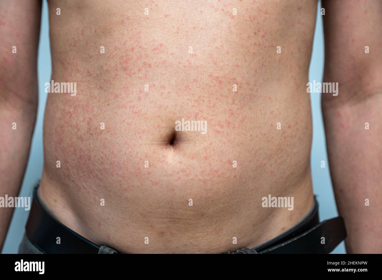 Dermatitis rash viral disease with immunodeficiency on body of young adult  asian, scratch with itch, Measles Virus, Viral Exanthem Stock Photo - Alamy