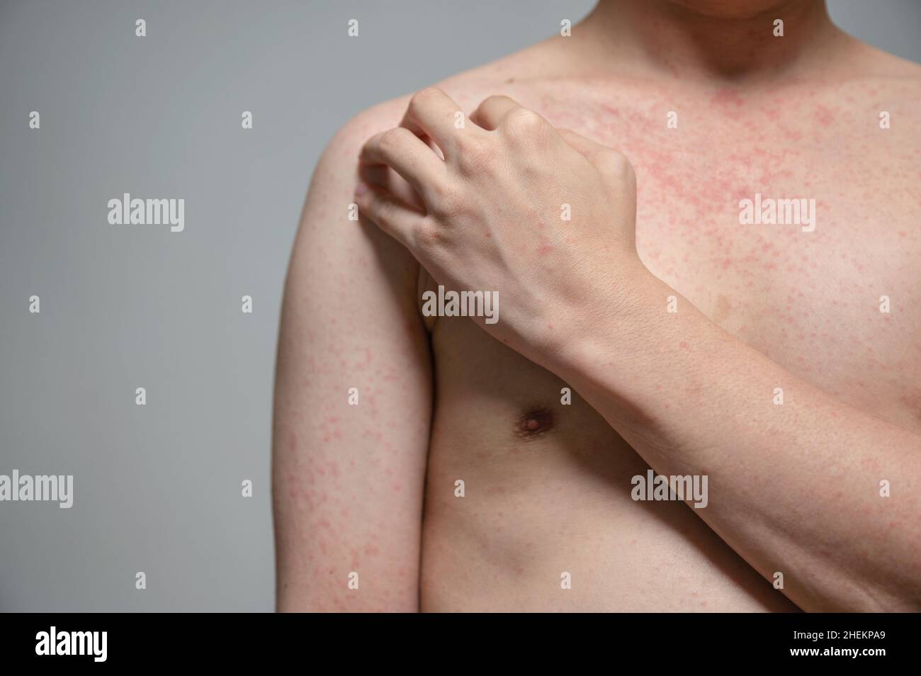 What Does Rubella Look Like In Adults