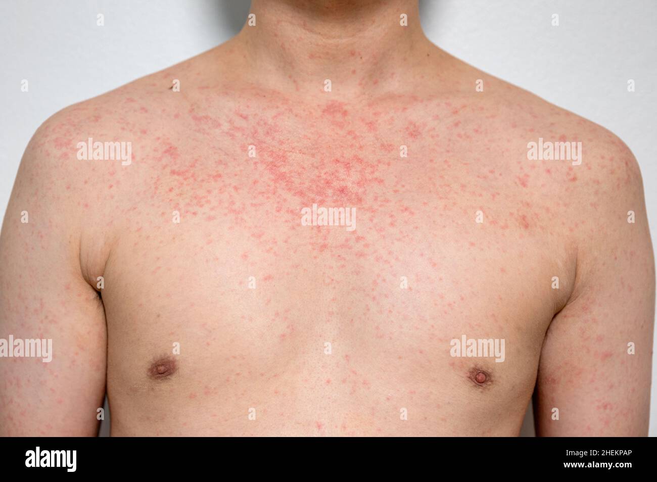 Dermatitis rash viral disease with immunodeficiency on body of young