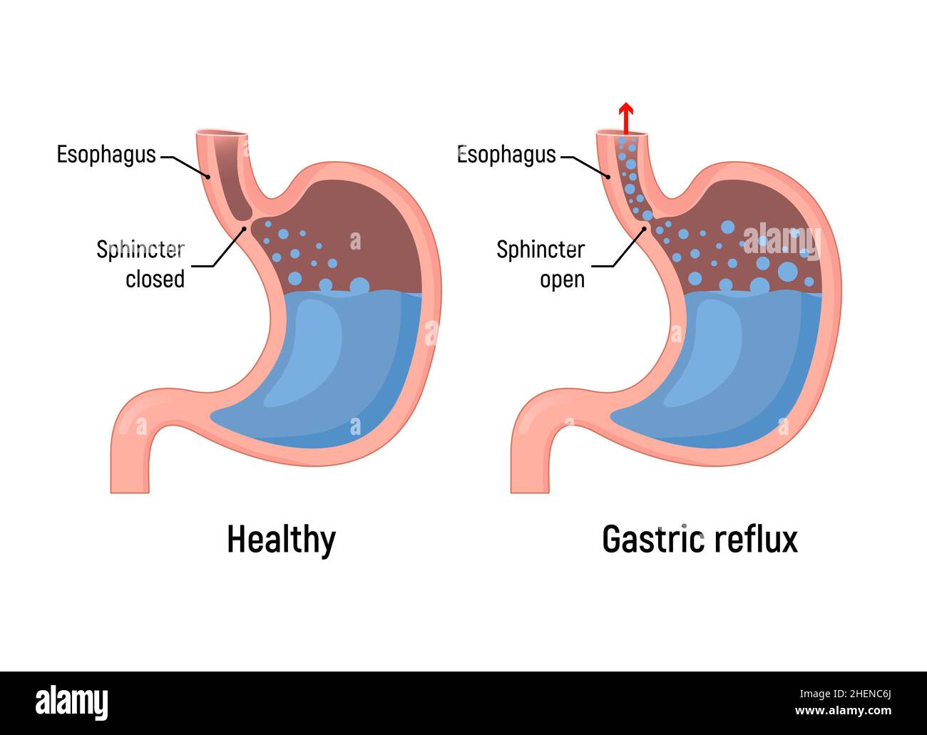Esophageal gastric reflux acid indigestion. Gastrointestial stomach