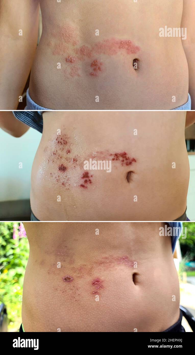 development of the shingles rash on the belly Stock Photo
