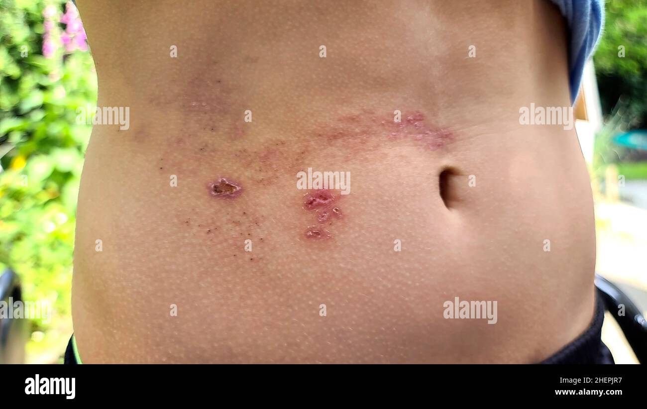 remittent shingles rash on the belly Stock Photo