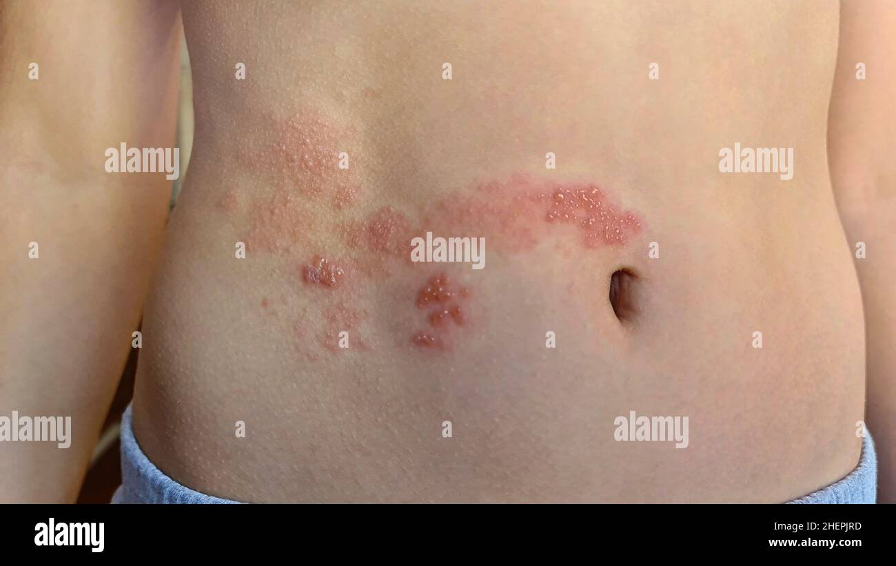shingles rash on the belly Stock Photo