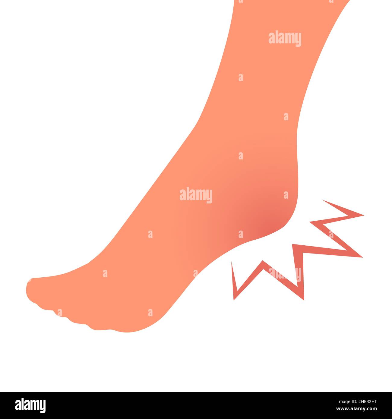 Leg with heel pain. Orthopedic disease plantar fasciitis. Beauty and health of feet. Vector isolated illustration Stock Vector