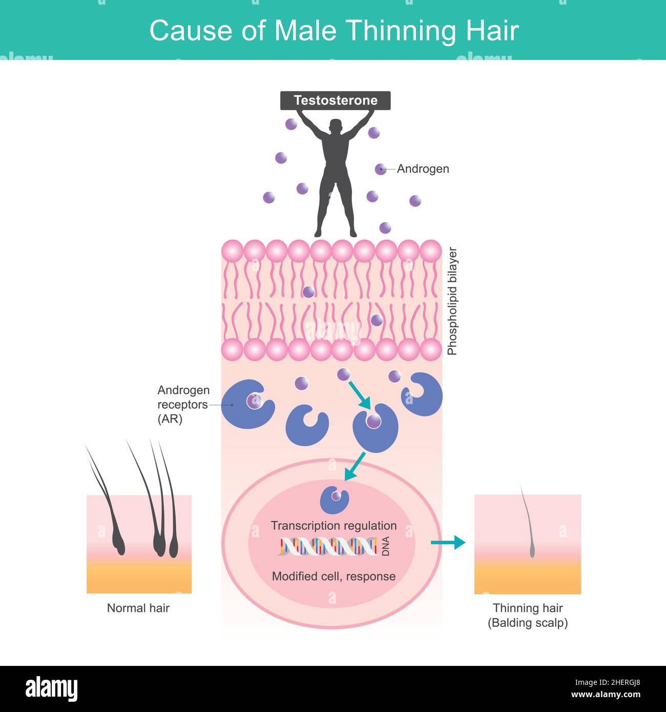 Cause of Male Thinning Hair. Illustration for explain problem male thinner hair cause from sensitivities androgen cells receptors Stock Vector