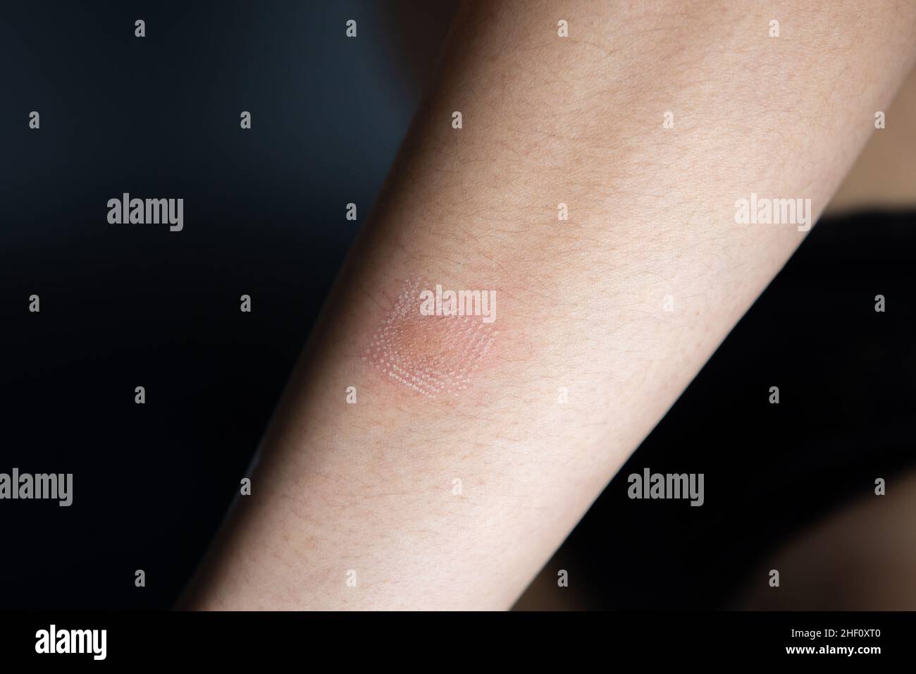 Marks after laser hair or atopic eczema scar removal from the skin. CO2