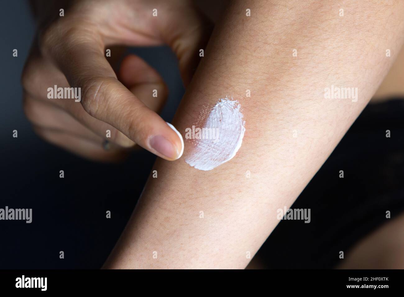 Marks after laser hair or atopic eczema scar removal from the skin. CO2  technique Stock Photo - Alamy