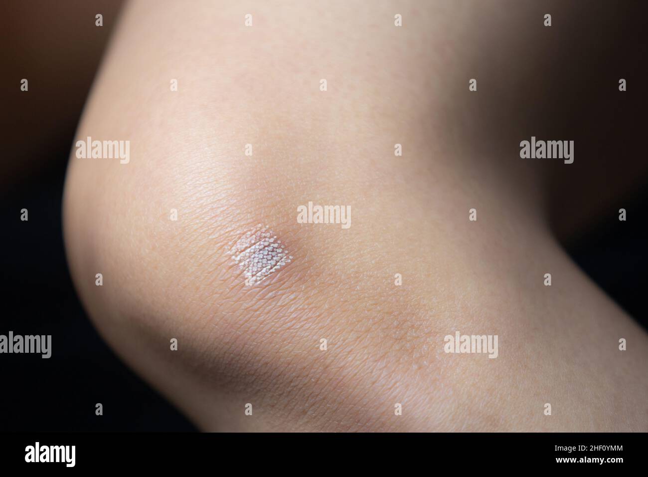 Marks after laser hair or atopic eczema scar removal from the skin. CO2 technique. Stock Photo