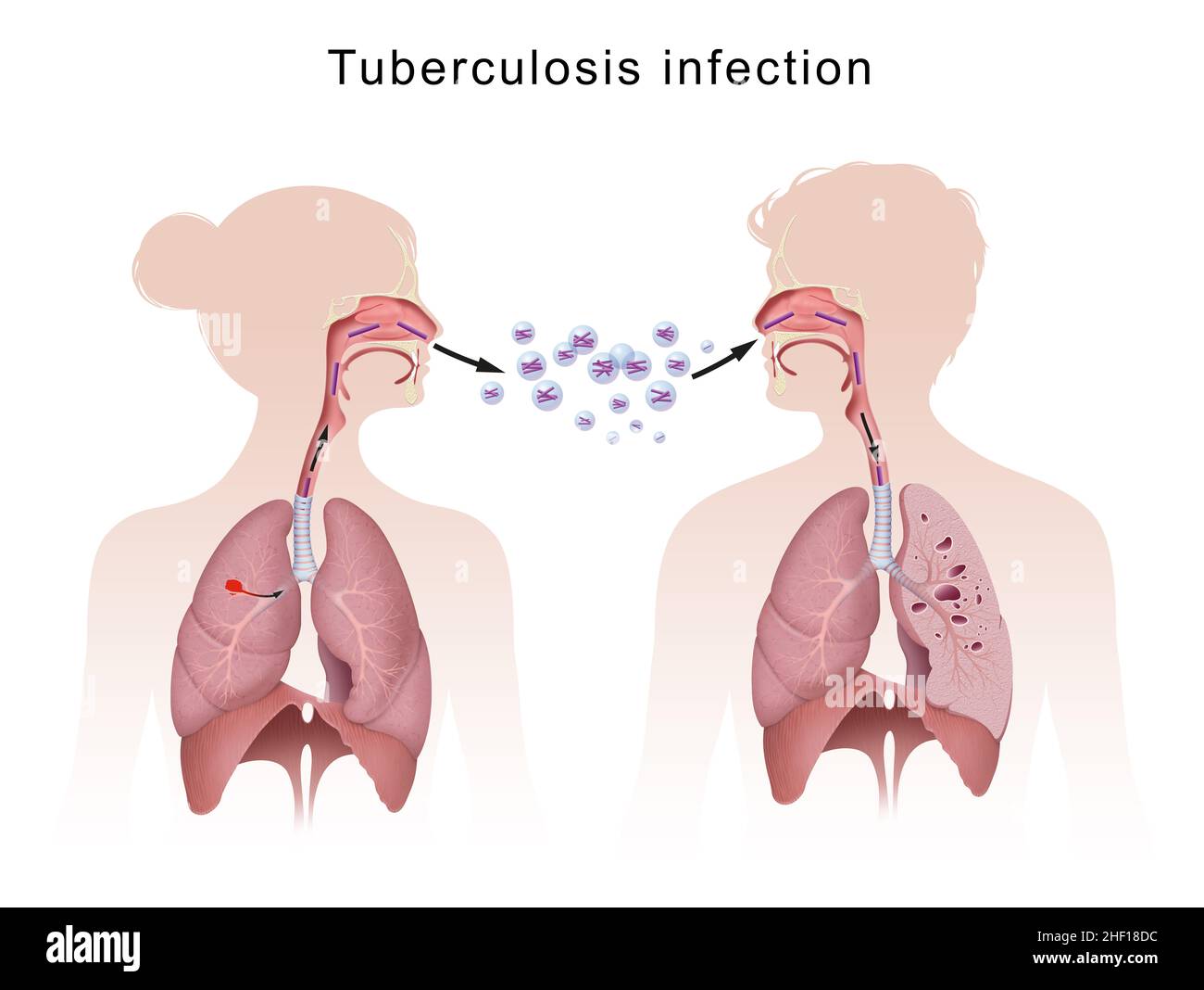 Tuberculosis is spread from one person to the next through the air Stock Photo