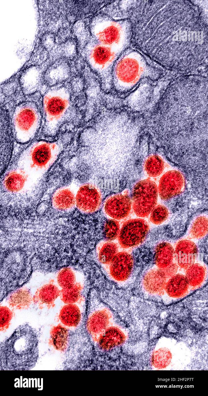 Novel Coronavirus SARS-CoV-2 electron micrograph 2 Stock Photo