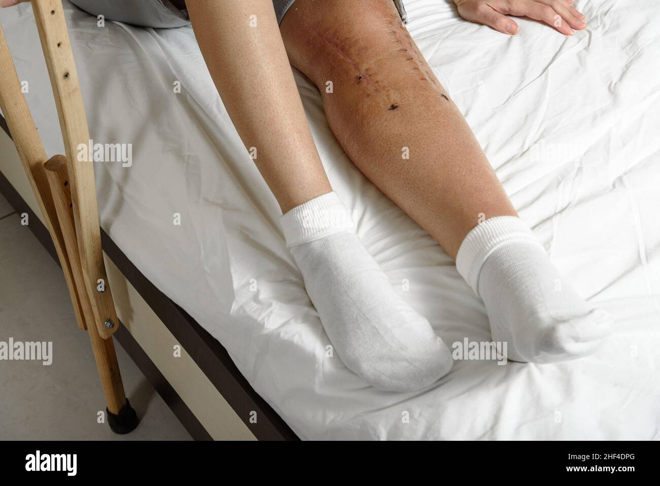 Female patient with postoperative suture after surgery on broken leg sitting on bed. Woman with knee fracture holding crutch Stock Photo