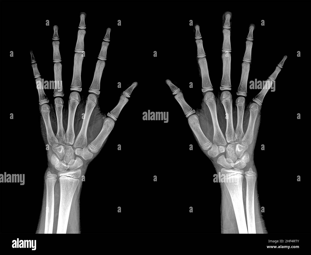 Comparison Radiography of hand left and right Stock Photo Alamy