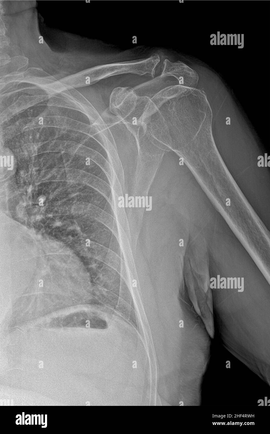 Radiography of the shoulder joint, after trauma Stock Photo Alamy