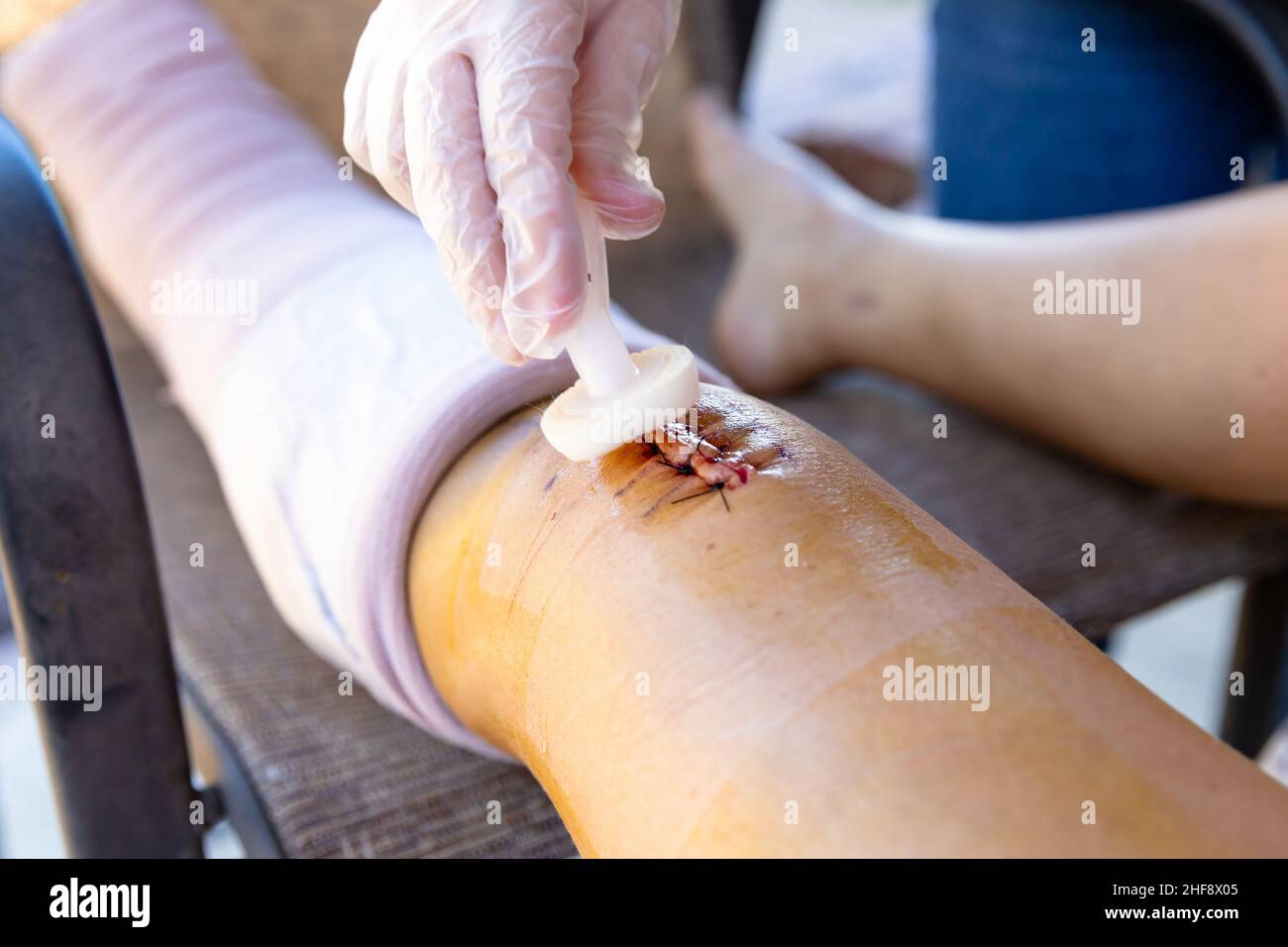 Cleaning wound and stitches after surgery Stock Photo