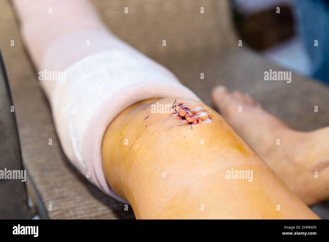 new wound and stitches after surgery Stock Photo