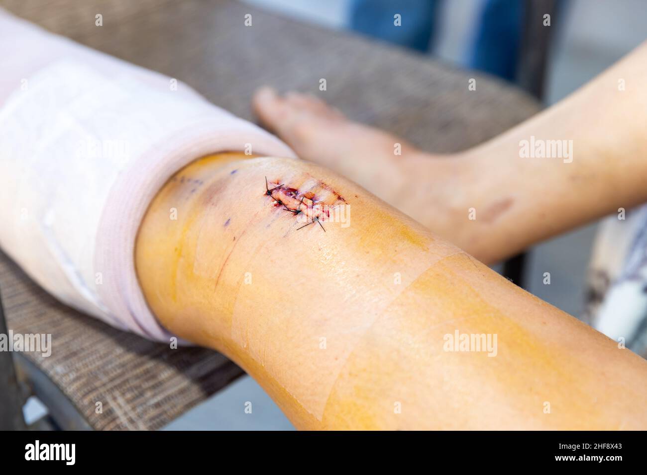 New incision and scar after knee surgery Stock Photo