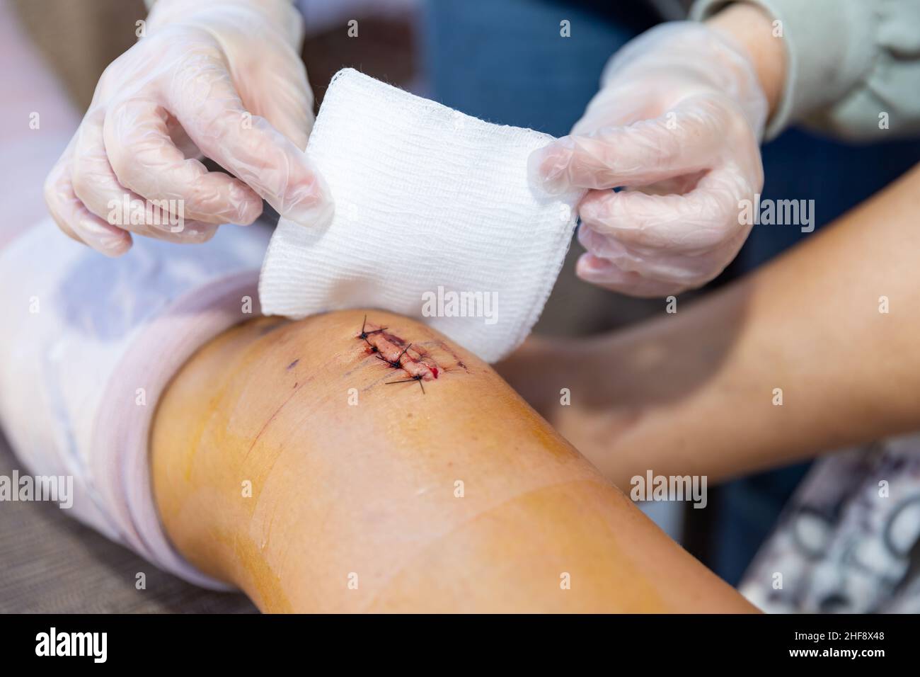 Cleaning and dressing incision and stitches after surgery Stock Photo