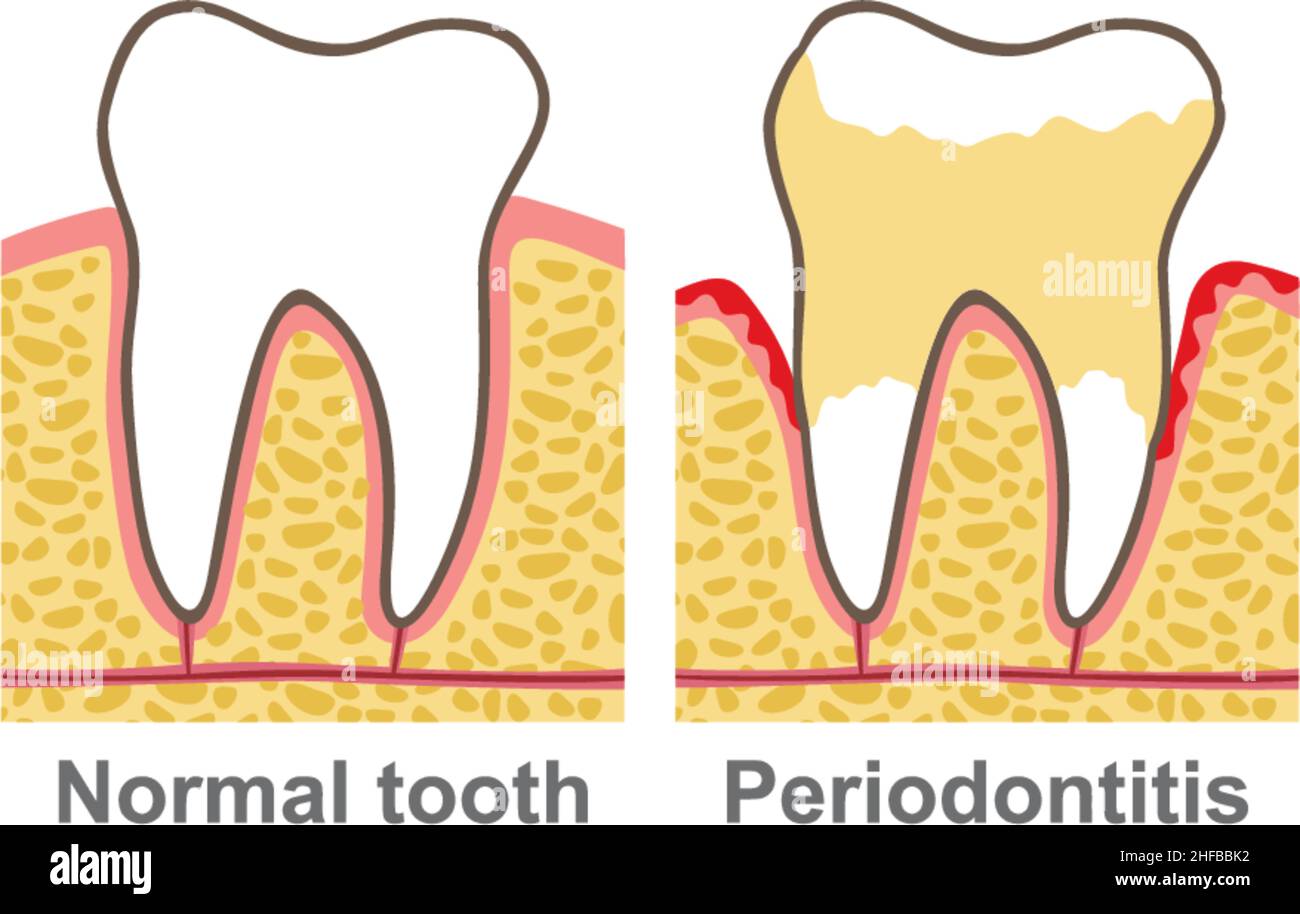 Human gum bleeding periodontal disease (oral care vector illustration