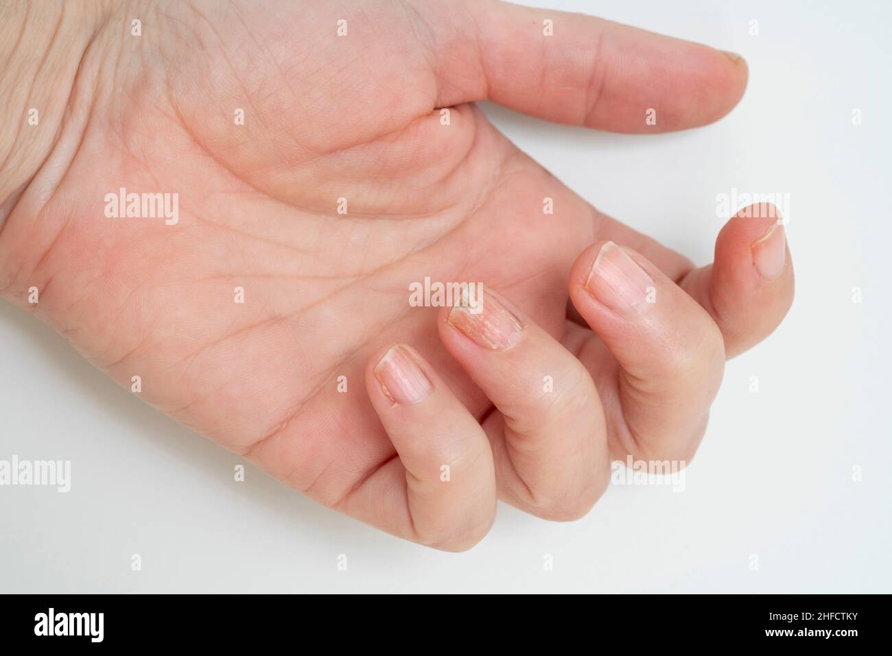 Nail Fungus Hands Disease Fungal Infection Nails Hands Finger Onychomycosis  Stock Photo by ©leravalera89 536396270