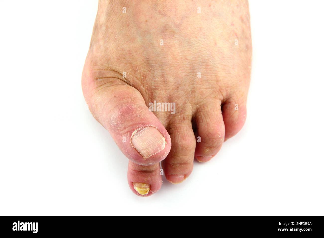 Sick feet with bunions, blisters and overlapped toes. Vascular problems