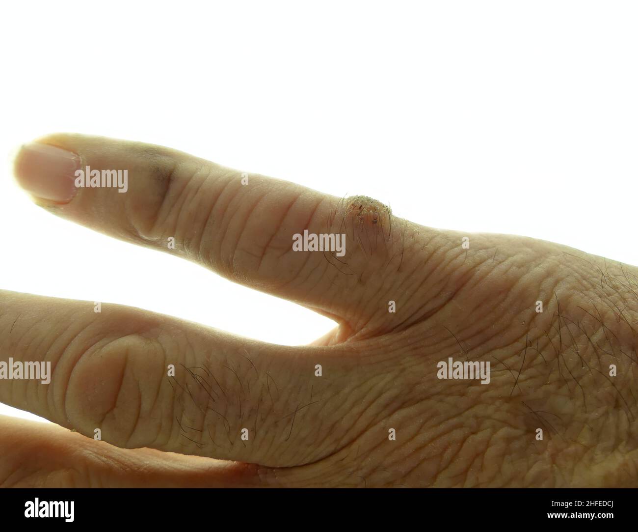 Hand of an elderly man on white background showing a benign malformation of the skin, a wart with hairs on one of the fingers Stock Photo