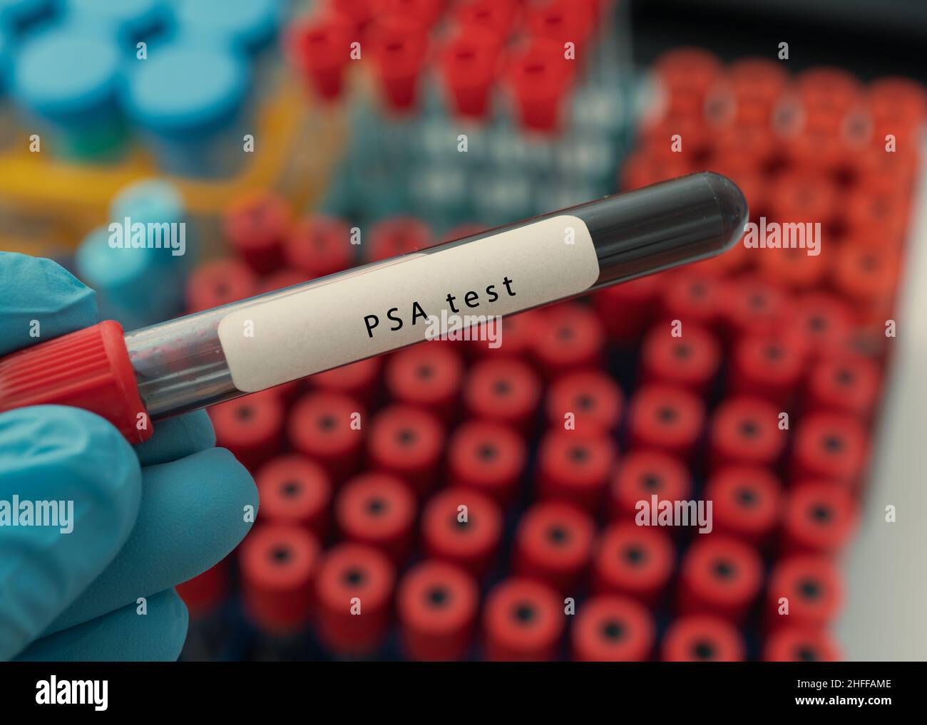 PSA test result with blood sample tube Stock Photo Alamy