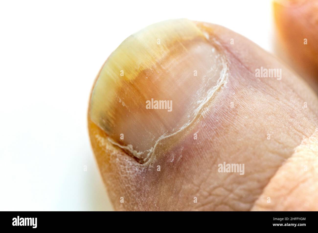 onychomycosis, The initial stage of mycosis. Big toe infected with fungal bacteria, Close up, White background Stock Photo