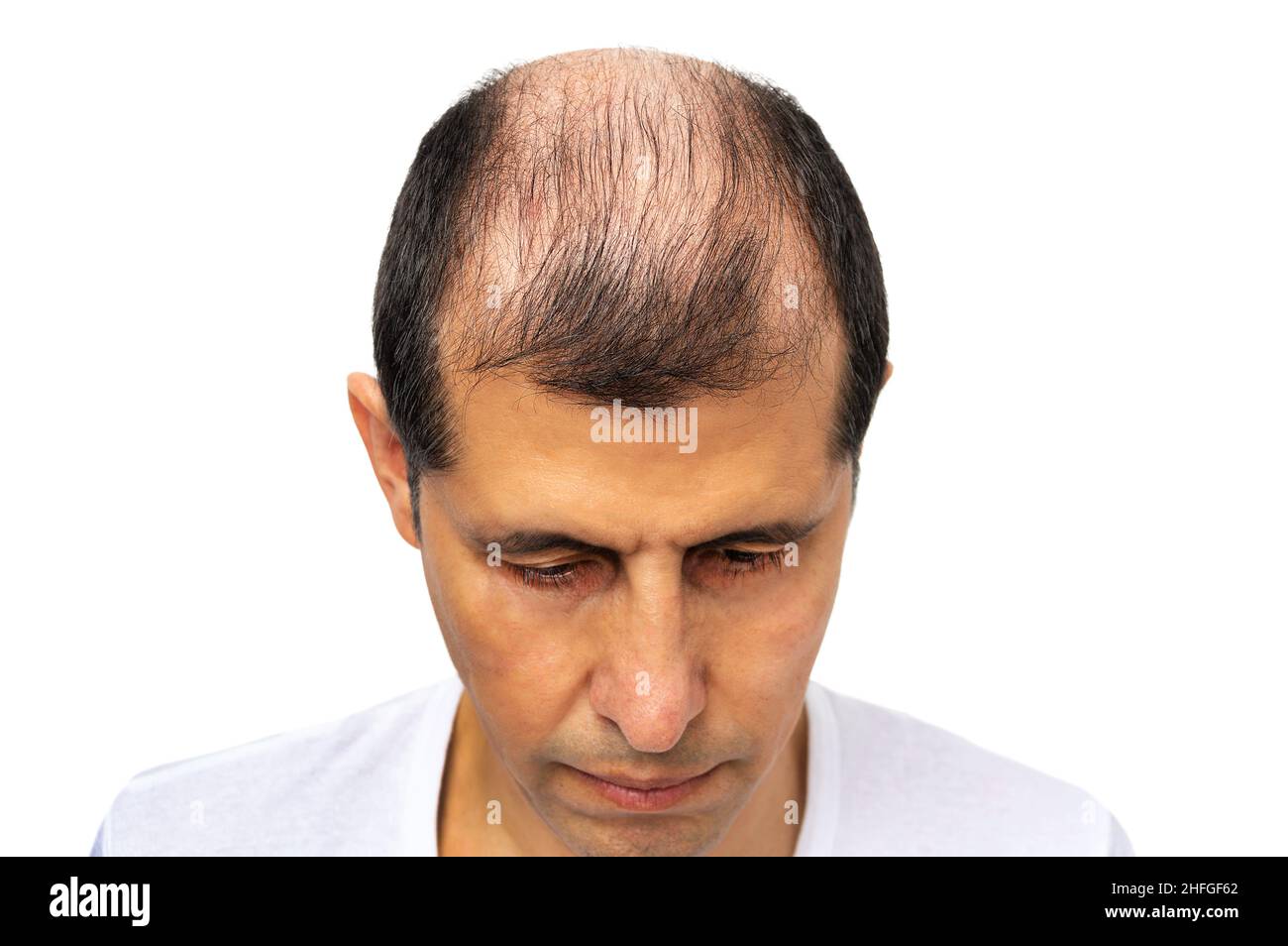 Hair loss concept. Head of man on white background, closeup Stock Photo