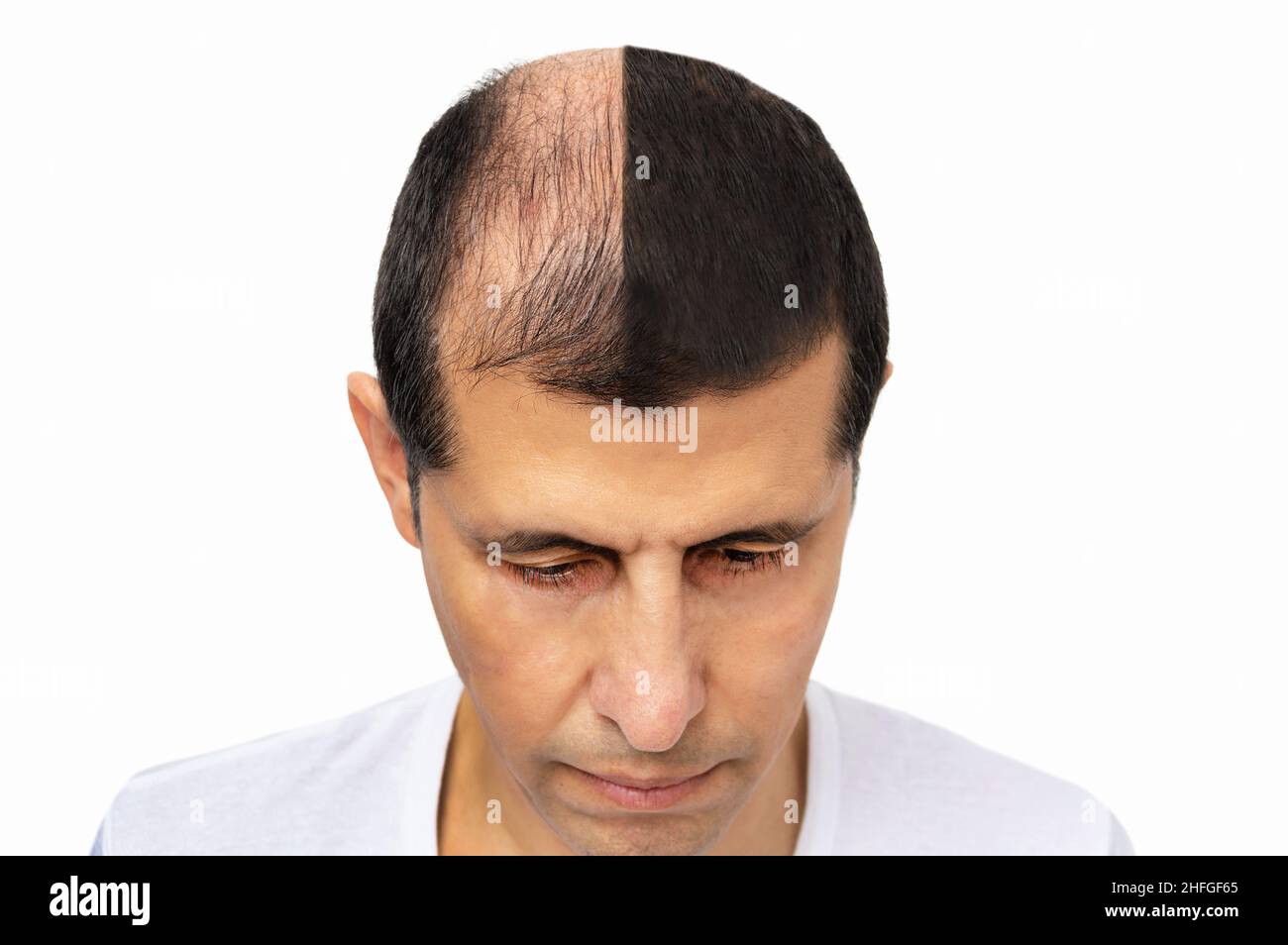 Man before and after hair loss treatment on white background Stock Photo