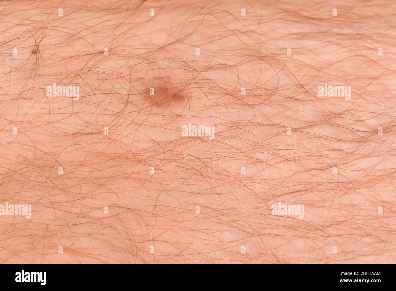 Red wound on the skin of a man's hairy leg, closeup Stock Photo Alamy