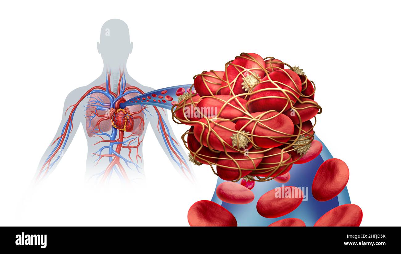 Pulmonary Embolism illness with a blood clot as a disease with a blockage of an artery in the lungs with 3D illustration elements. Stock Photo