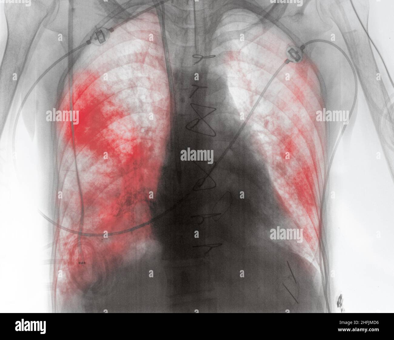 X-ray image of patient with lung inflammation in the early post-surgery period. Stock Photo