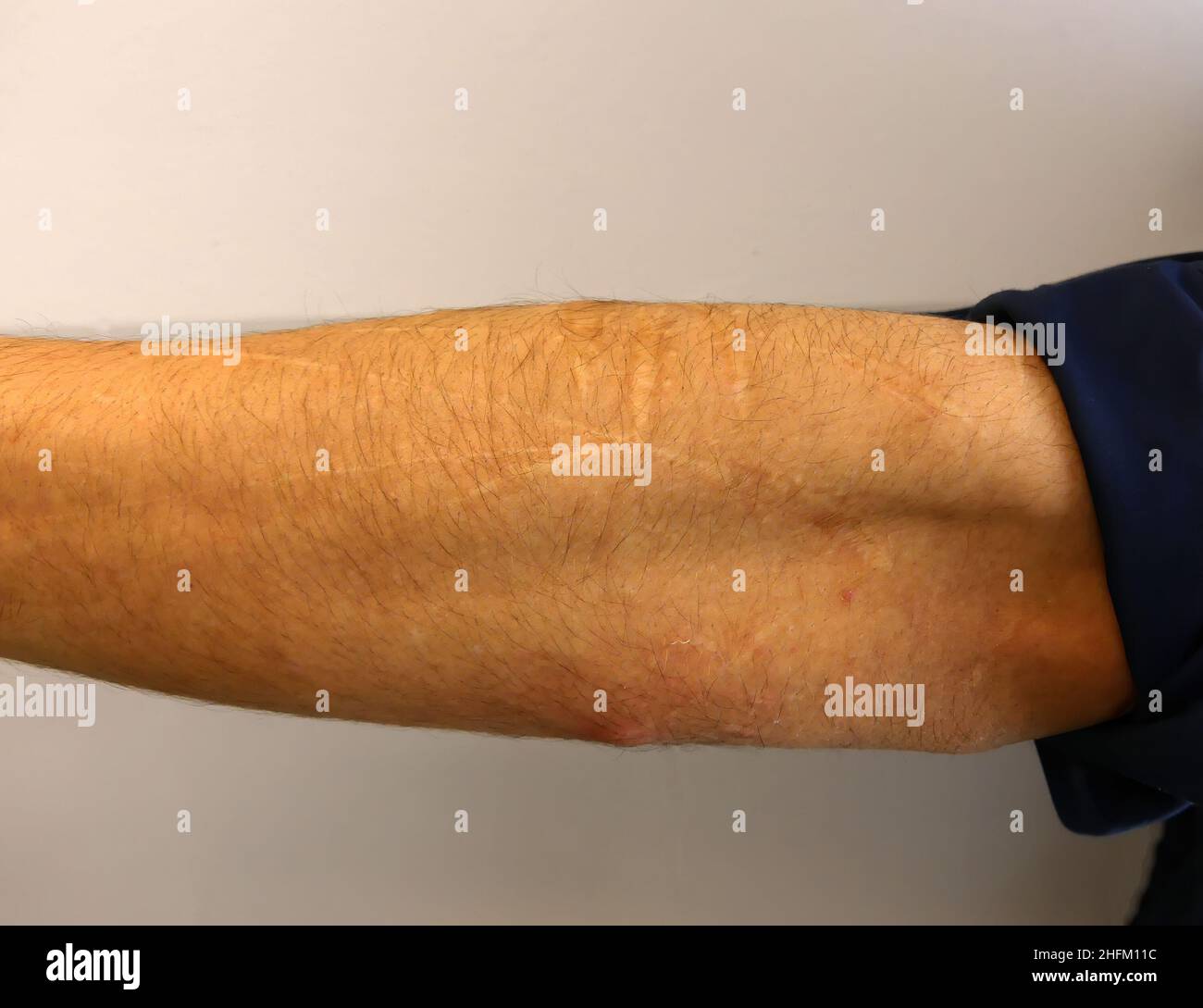 Obsessive-compulsive mental disorder self-inflicted scars on the arm of a Caucasian male Stock Photo