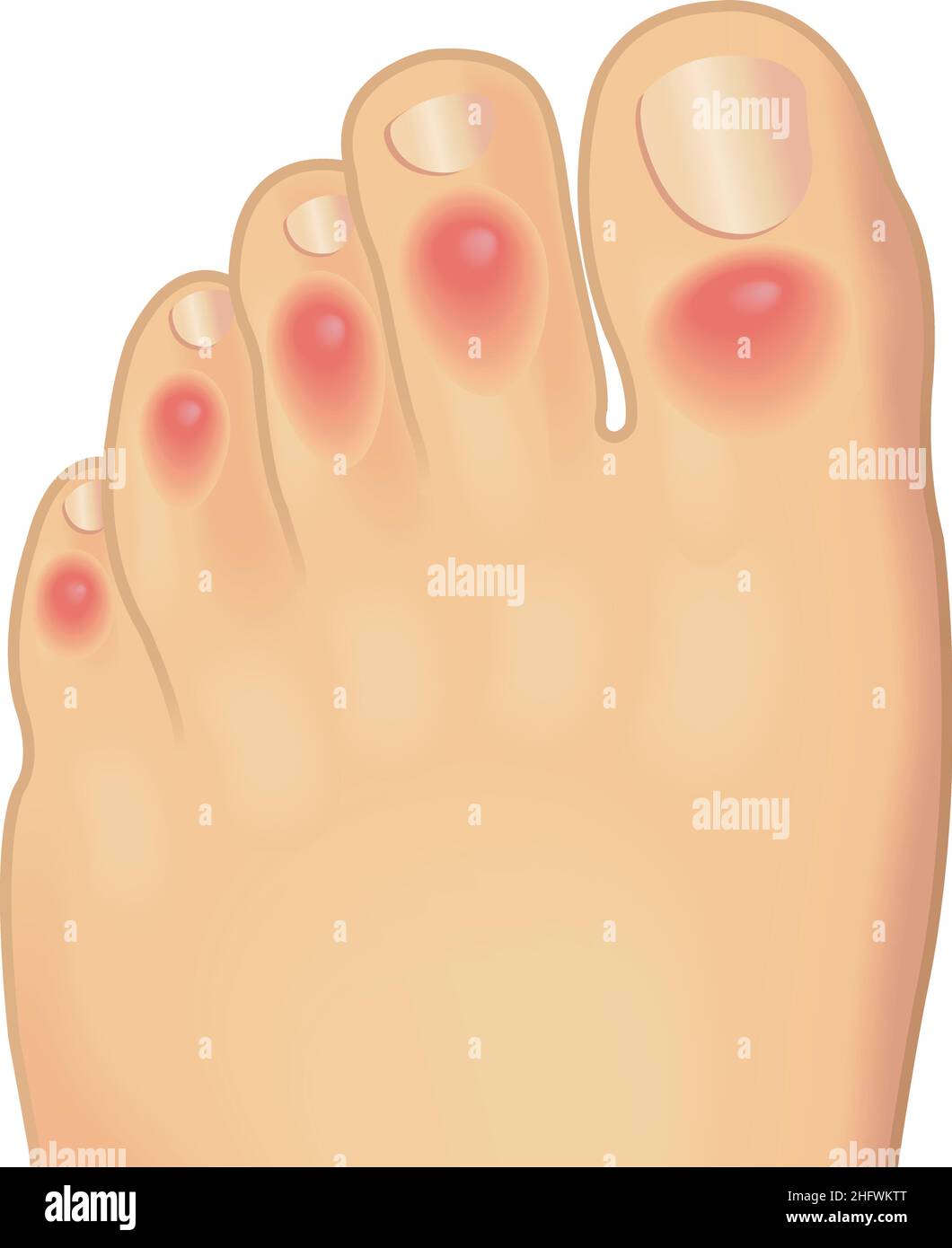 Medical illustrations of the toes afflicted from chilblains. Stock Vector