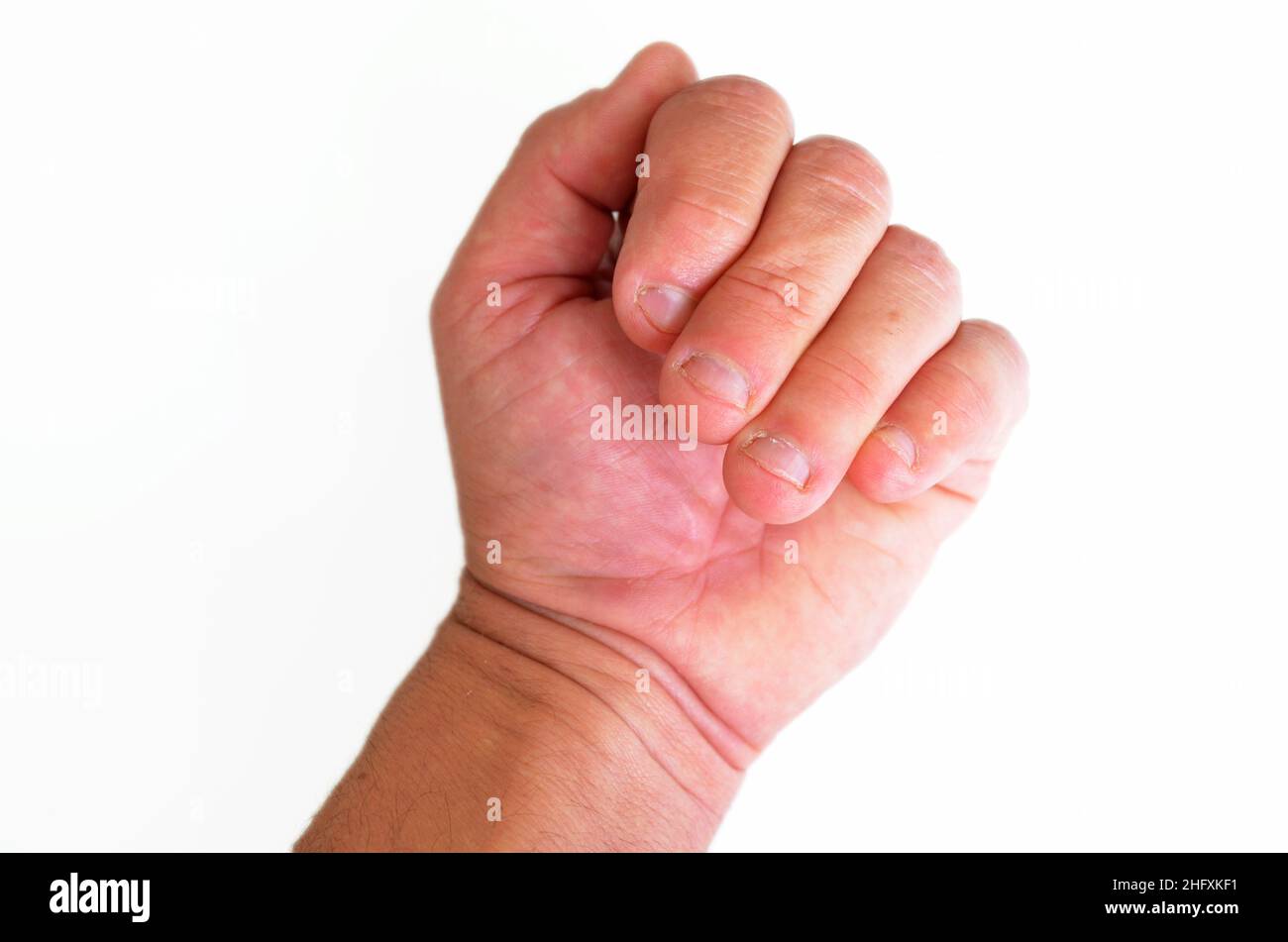 Whitlow finger hires stock photography and images Alamy