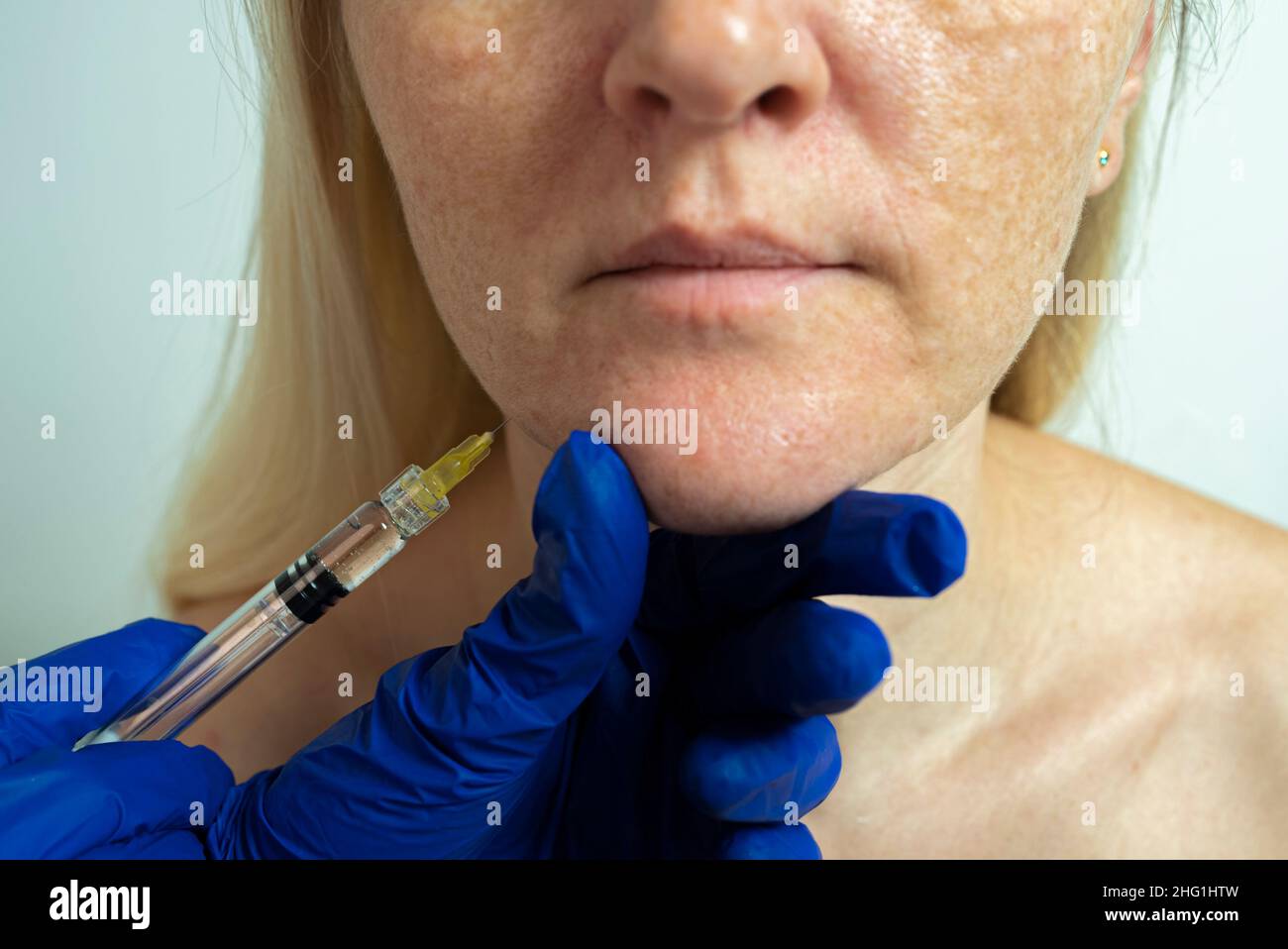 Needle mesotherapy in a beauty clinic. Cosmetics are injected into the woman's face Stock Photo