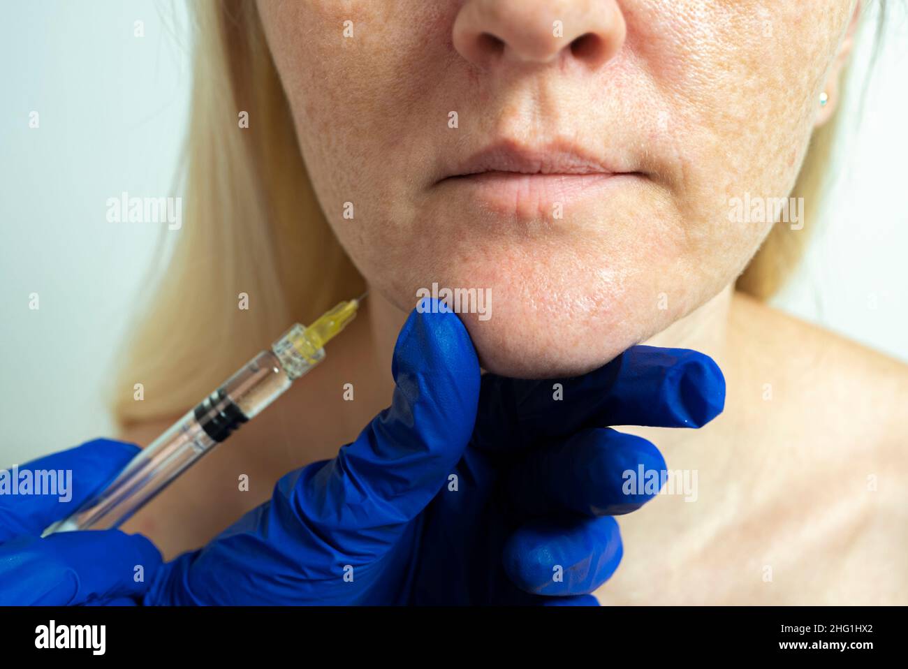 Needle mesotherapy in a beauty clinic. Cosmetics are injected into the woman's face Stock Photo