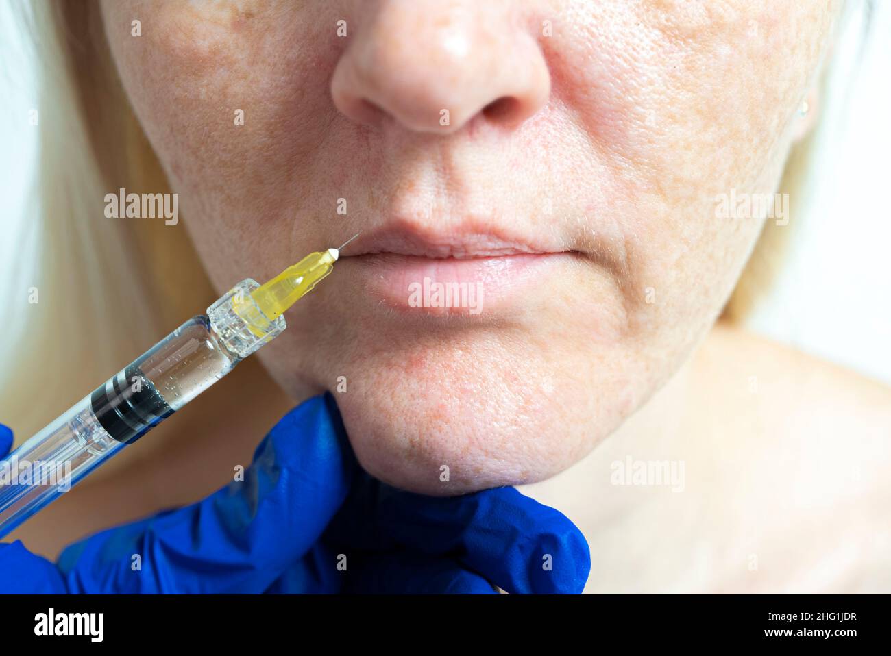 Needle mesotherapy in a beauty clinic. Cosmetics are injected into the woman's face Stock Photo